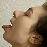 асид мелани Голе